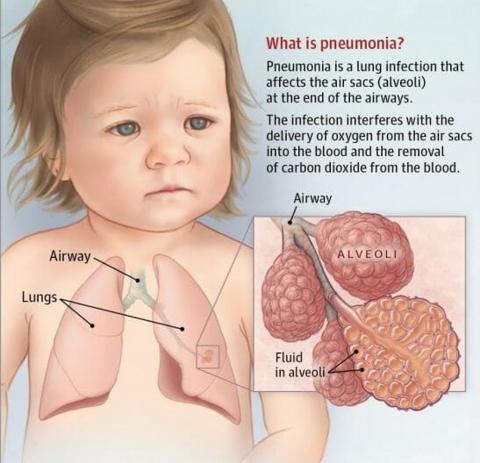 الالتهاب الرئوي الحاد عند الاطفال L أسبابه