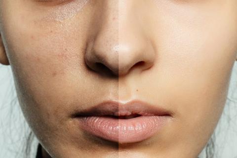 تصبغات الوجه والبشرة L ما سبب ظهور تصبغات الوجه ؟ وما هي طرق التخلص منها بشكل فعال ؟