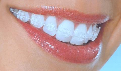 تقويم الأسنان الشفاف L فوائد ومدة لبس التقويم