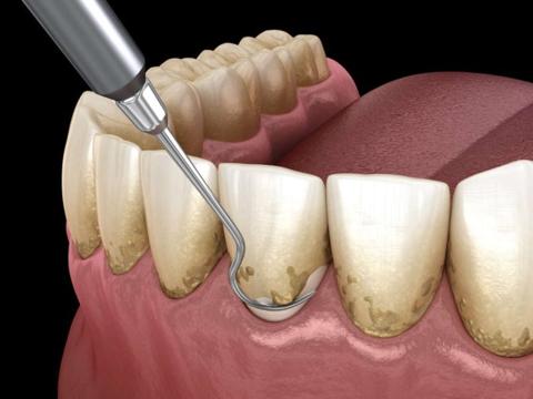 ما هو جير الأسنان ؟ لماذا يصاب البعض بالجير ؟