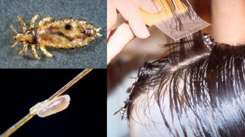 حشرات أو قمل الشعر L أعراضه – اعرفى إزاى ممكن