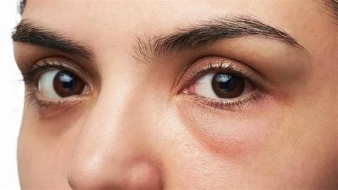 علاج نقص الكولاجين تحت العين | نصائح للتخلص من