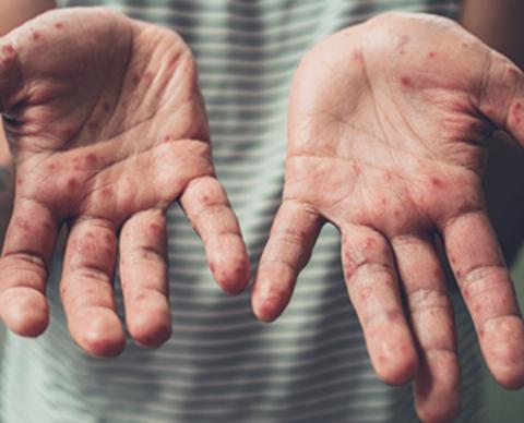 ما هي متلازمة اليد والقدم ؟ أعراض هذه المتلازمة