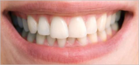 منتجات إزالة اصفرار الاسنان من الصيدلية | طريقة